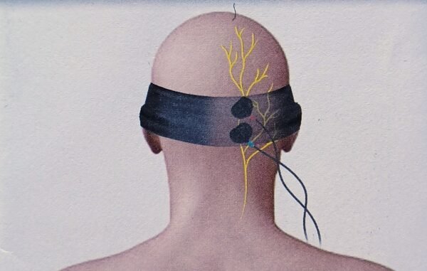 postion des electrodes kit d'arnold